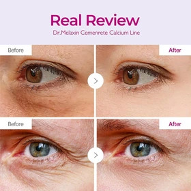 پچ دور چشم کلسیم ضدپف و حجمدهنده زیر چشم دکتر ملاکسینDr.Melaxin